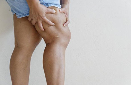 Deep Vein Thrombosis